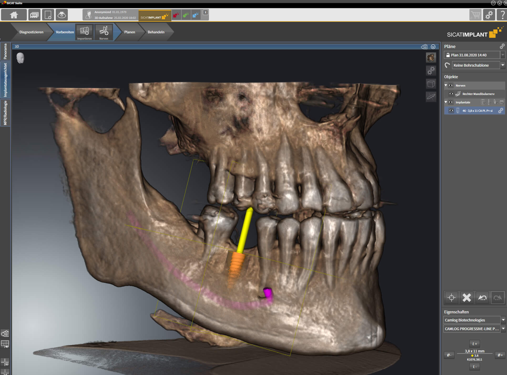 Digitale Implantatplanung mit DÜRR DENTAL SICAT Implant 2.0