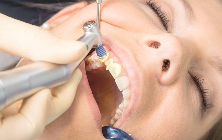 Mit einer zur Zahnhartsubstanz und das umgebende Weichgewebe schonenden Politur wird in der Prophylaxesitzung eine glatte Oberfläche erreicht.